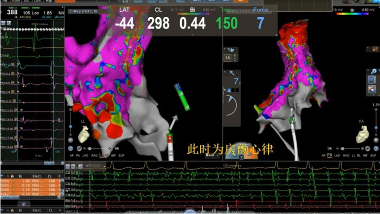 “心”的突破|四川南部縣人民醫院心血管內科順利完成一例複雜房性心律失常射頻消融術